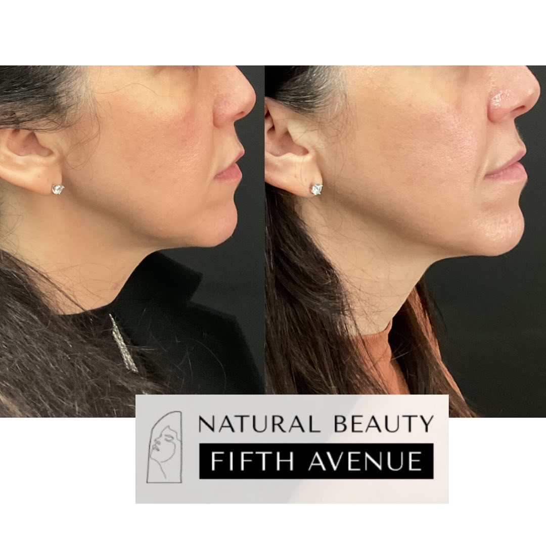 Before and after side profile showing improved jawline definition and volume after Sculptra dermal filler treatment